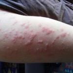 Bed Bugs Alert –Symptoms